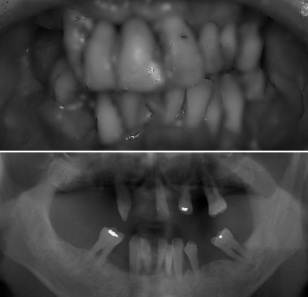 歯周治療の初診時レントゲン写真